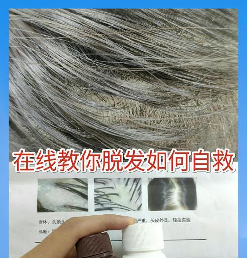 如何自救头发掉的太严重（15个方法教你有效预防头发掉落）